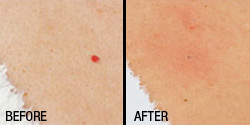 Skin tags removal, pigmentation and vascular blemishes removal ...